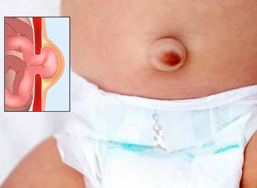 Umbilical Hernia consultation at Niraaya Hospital